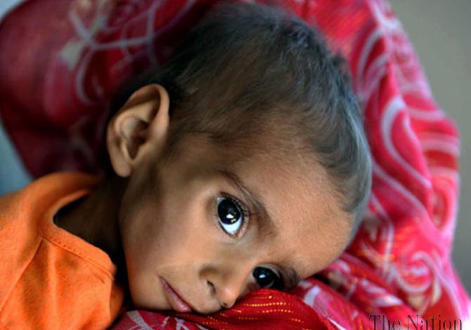 Global malnutrition worries UN agency