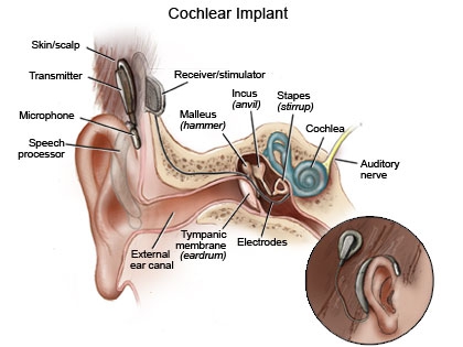 Tehran hosts Intl cochlear implant congress