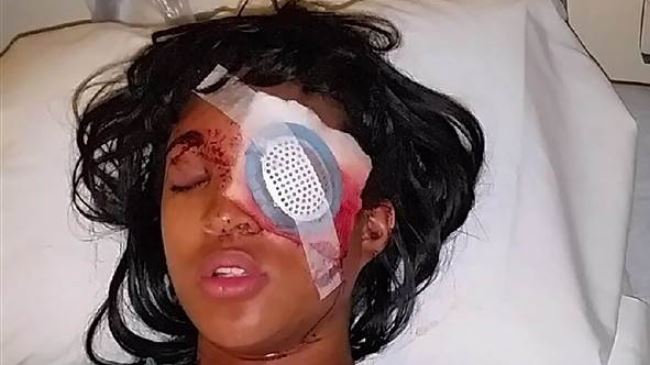 Pregnant black woman shot by US police, lost eye 
