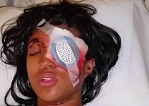 Pregnant black woman shot by US police, lost eye 