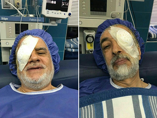 Ironic surgeries on rightists left eye, leftists right eye!