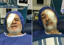 Ironic surgeries on rightists left eye, leftists right eye!