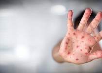 Iran reports first case of monkeypox