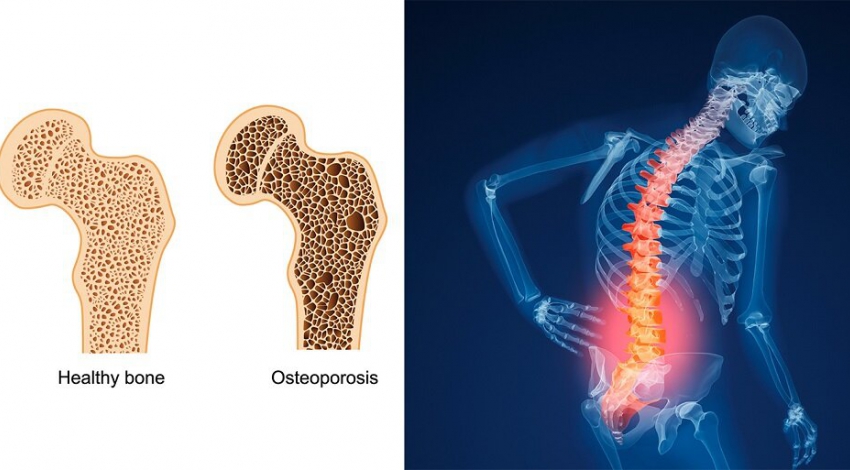 Osteoporosis: today