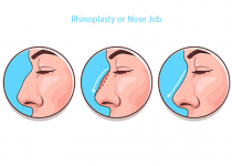 Is it Safe to Get a Nose Job in Turkey?