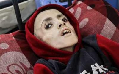 کودک فلسطینی دچار سوء تغذیه